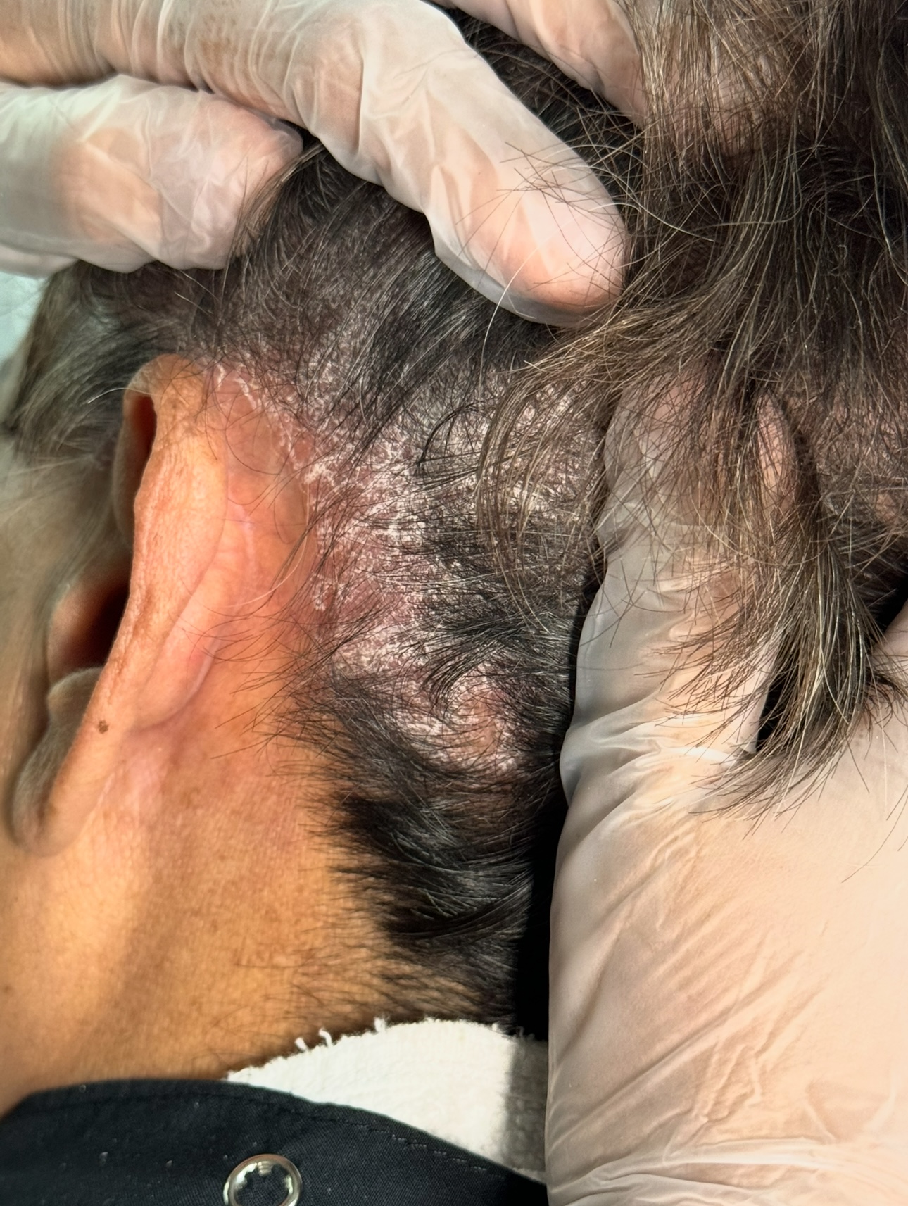 Psoriasis Capilar