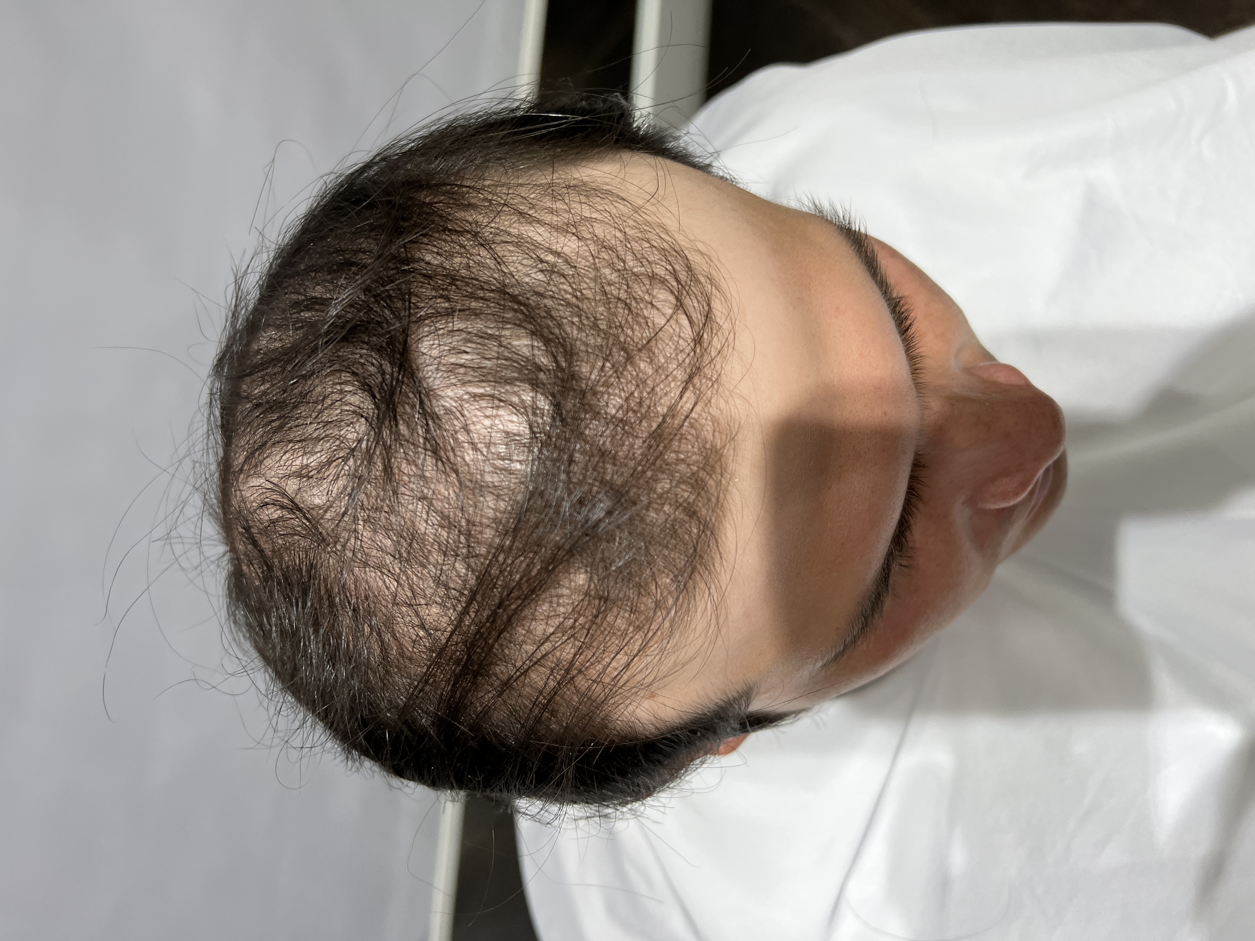 Alopecia Androgenética antes