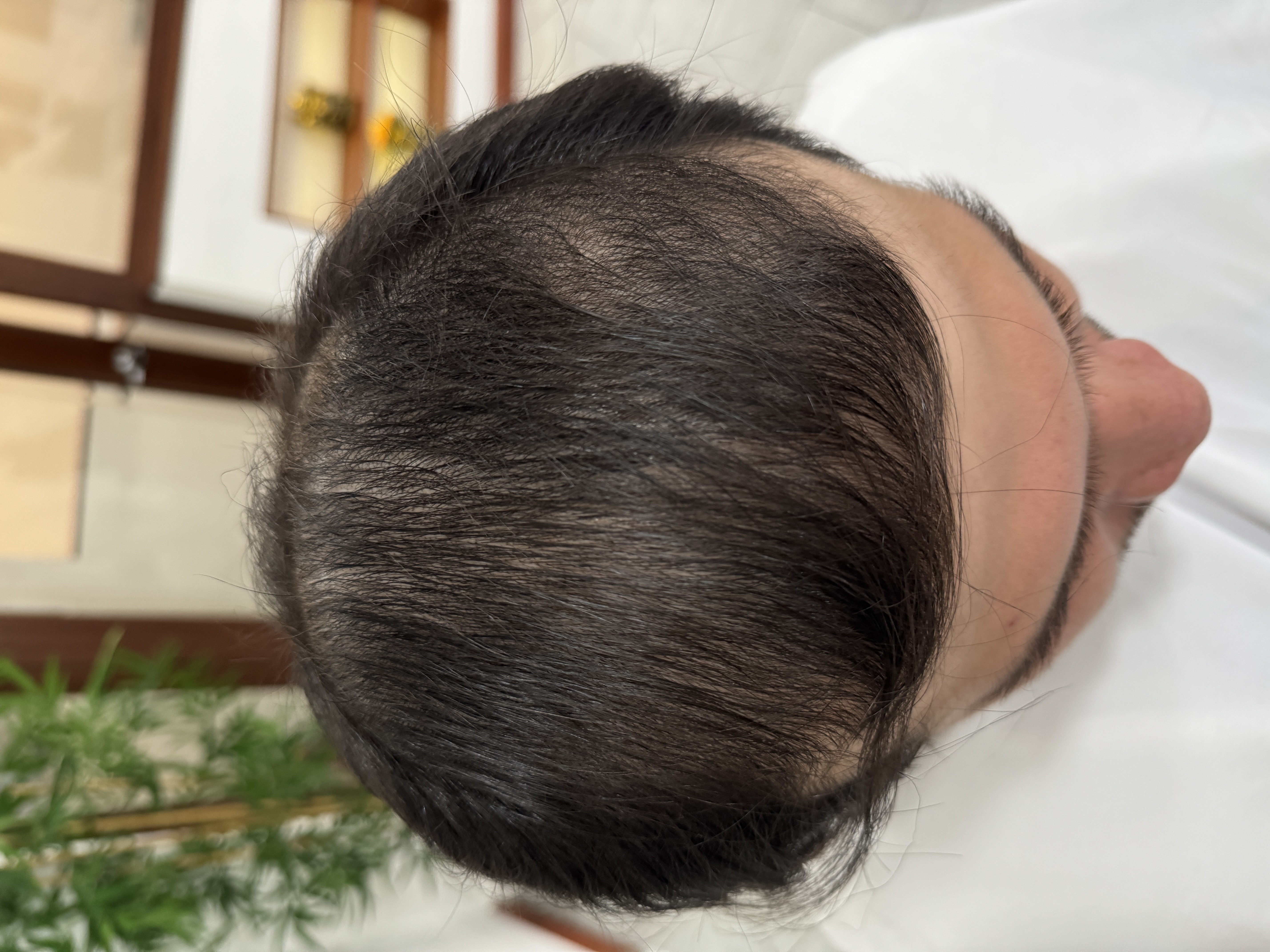 Alopecia Androgenética después