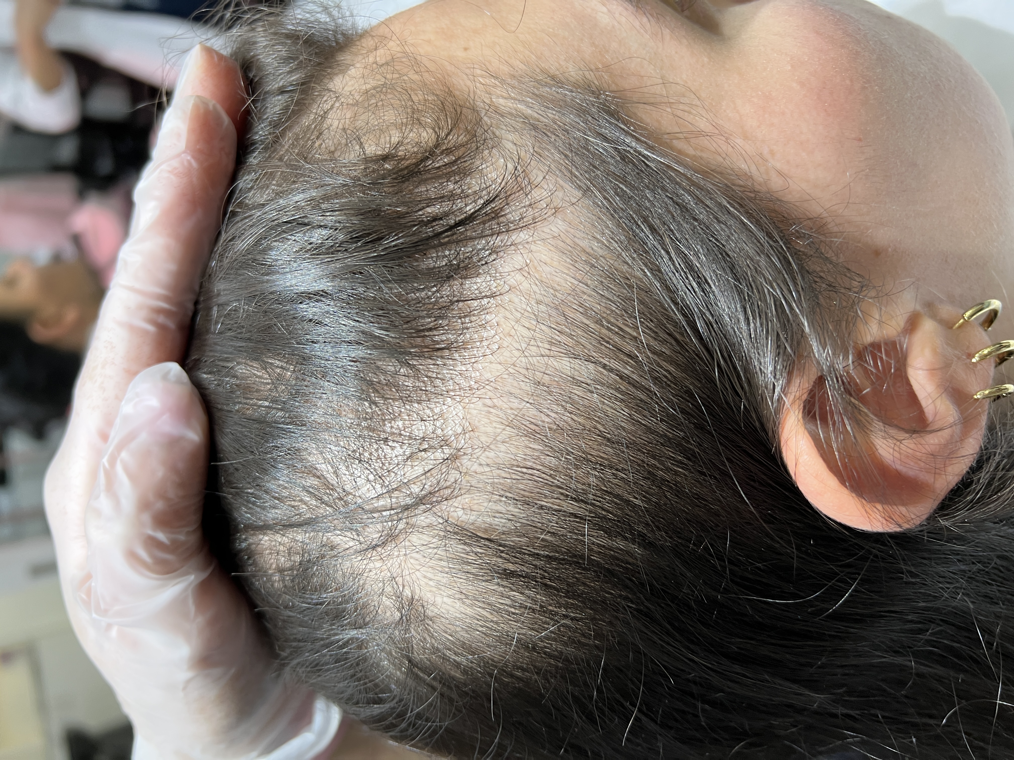 Alopecia Androgenética mujer antes