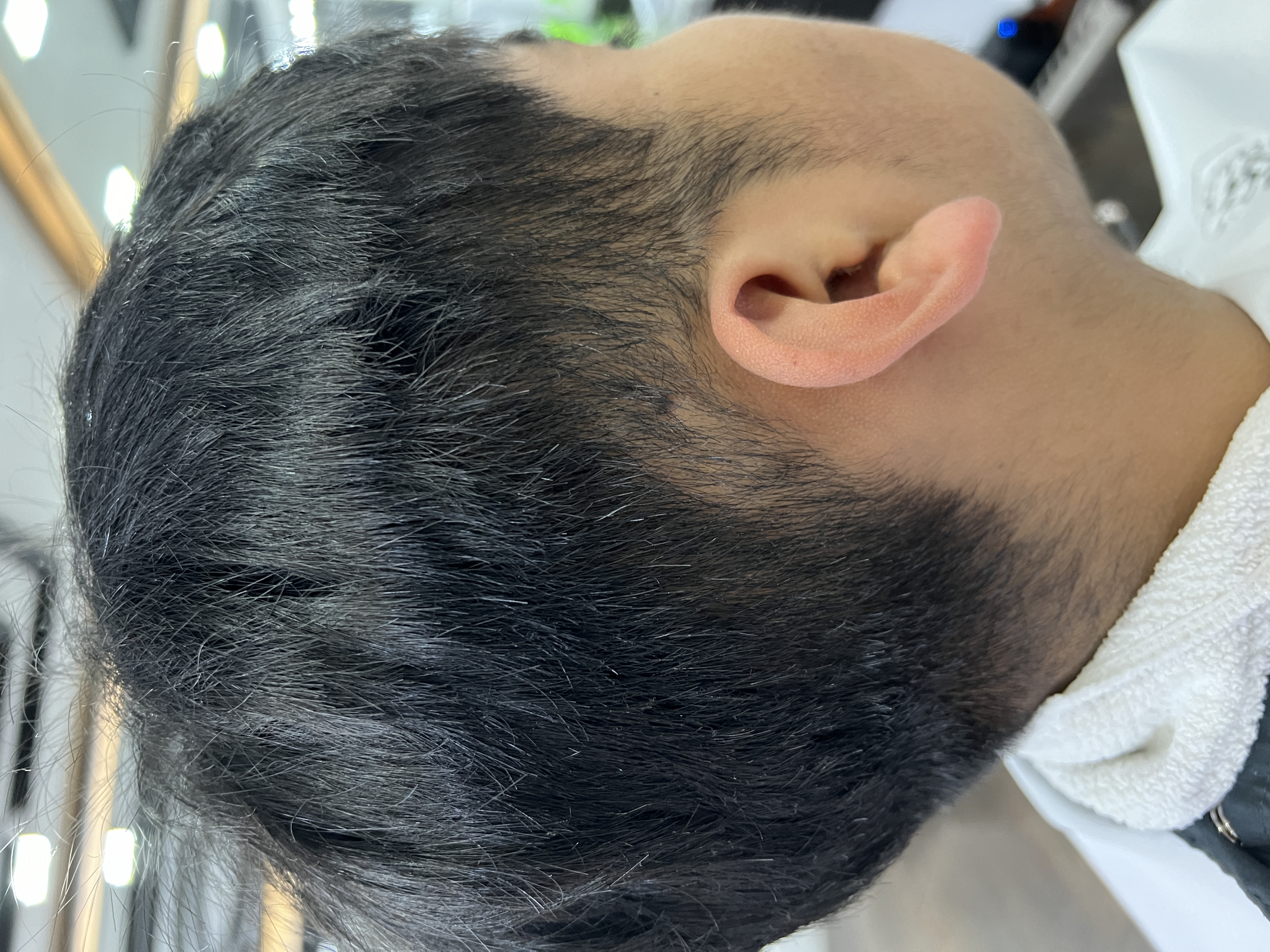 Alopecia Areata después