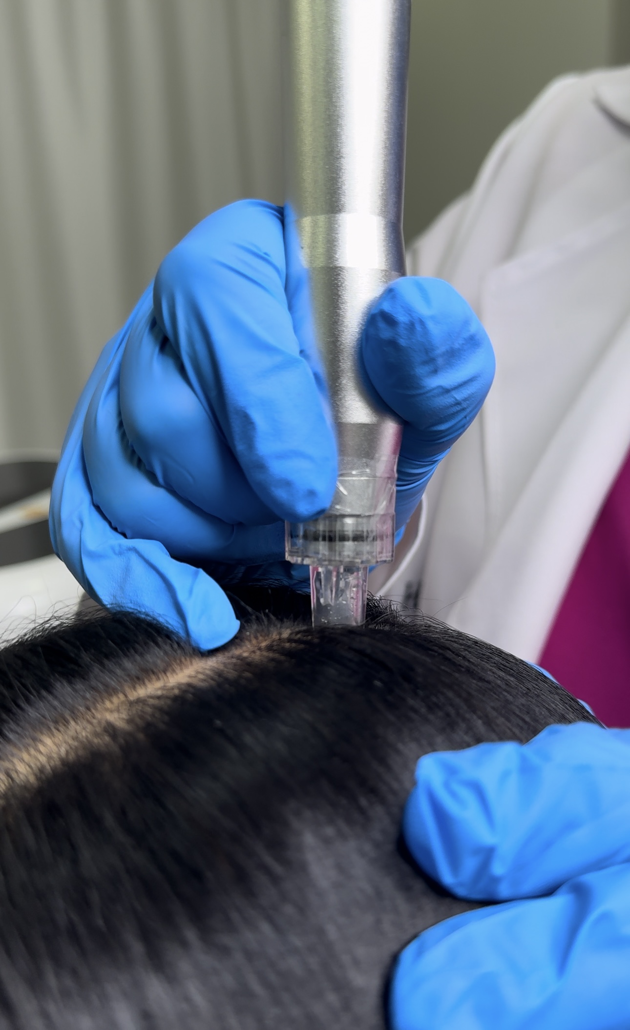 Mesoterapia Capilar