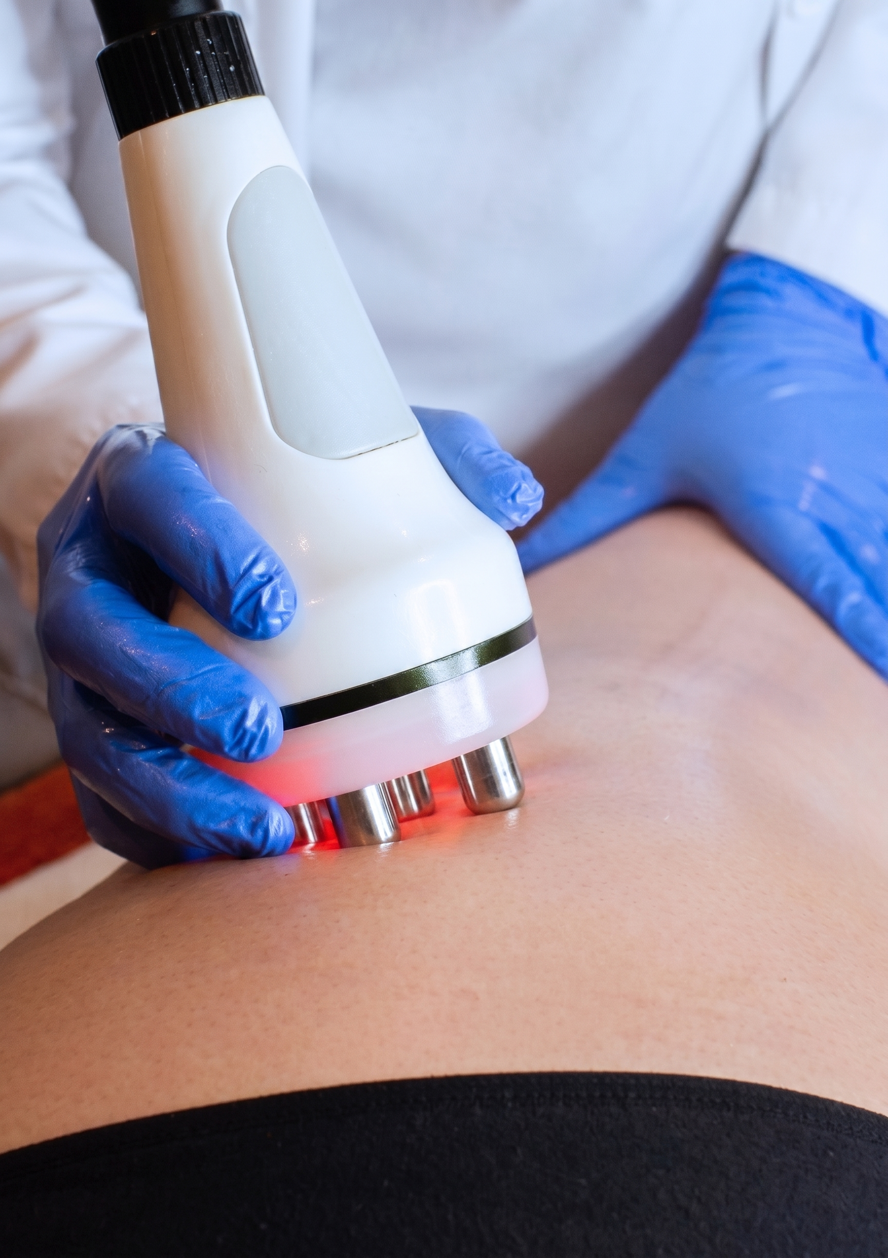 Radiofrecuencia Corporal